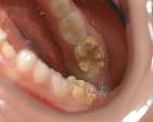 chalky teeth